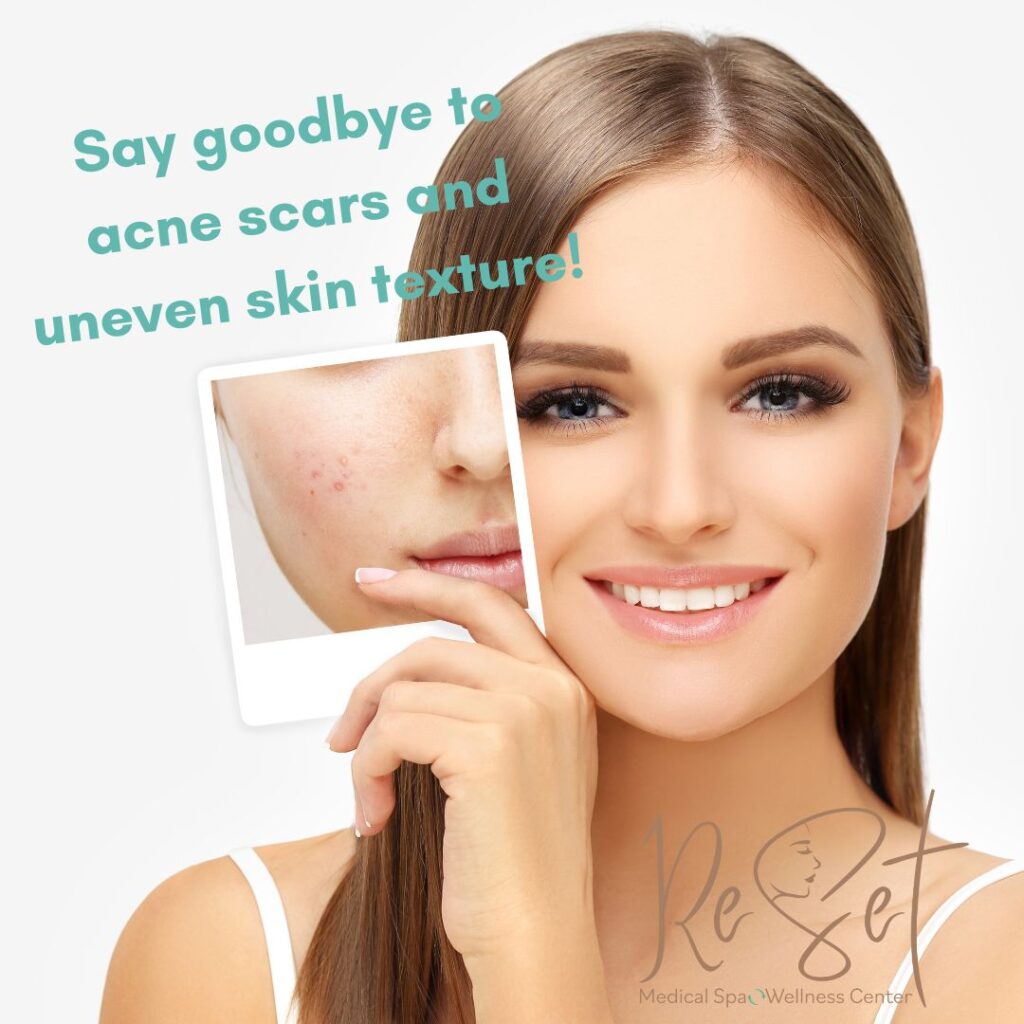 Before/After image of young woman with acne blemishes. 