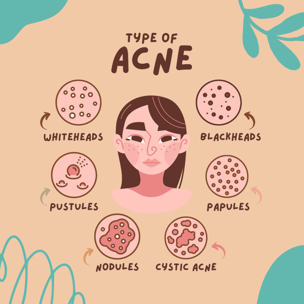 Graphic showing different types of acne